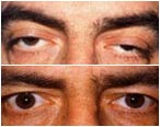 Left eye drooping of eyelid before and after surgery